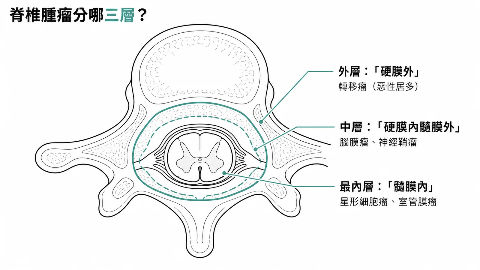 脊椎腫瘤三層分類示意圖