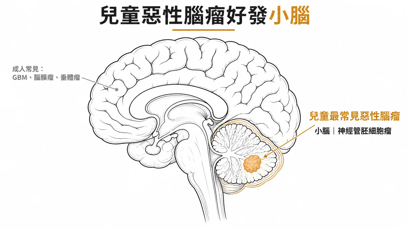 兒童惡性腦瘤好發小腦示意圖