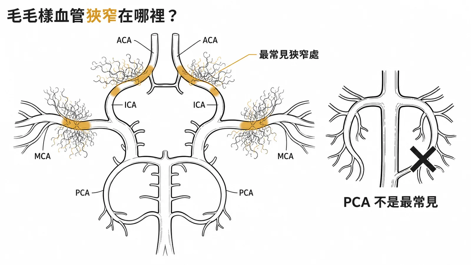 毛毛樣血管疾病好發部位為ICA末端而非PCA