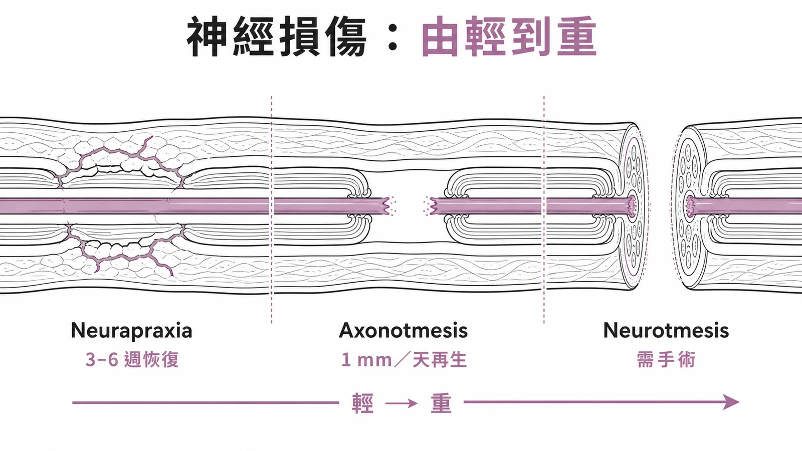 Seddon神經損傷三級分類與恢復時間示意圖