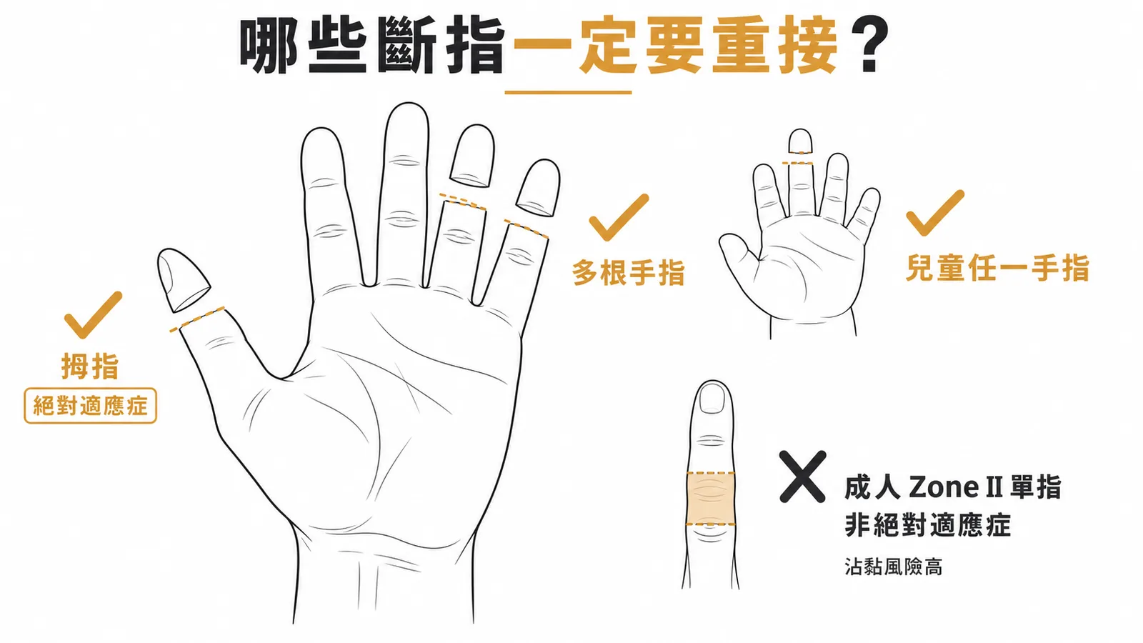 斷指重接絕對適應症與非絕對適應症示意圖