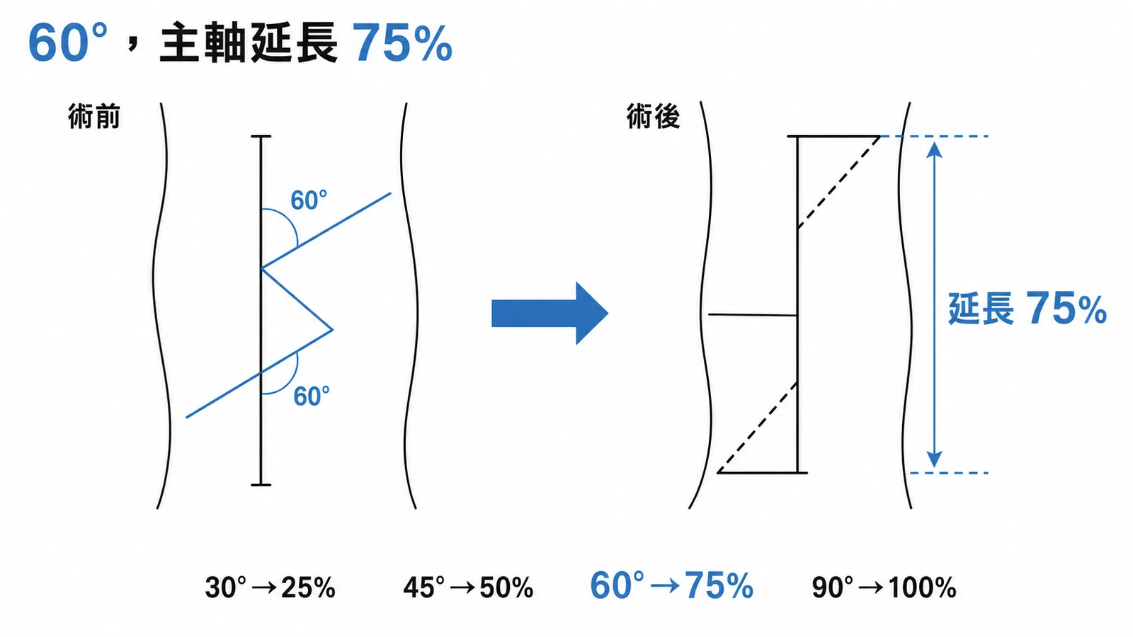 Z-plasty各角度延長比例對照圖