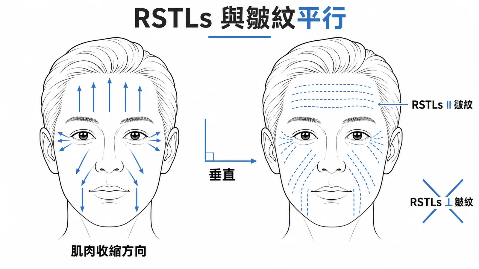 皮膚張力鬆弛線RSTLs與皺紋平行示意圖
