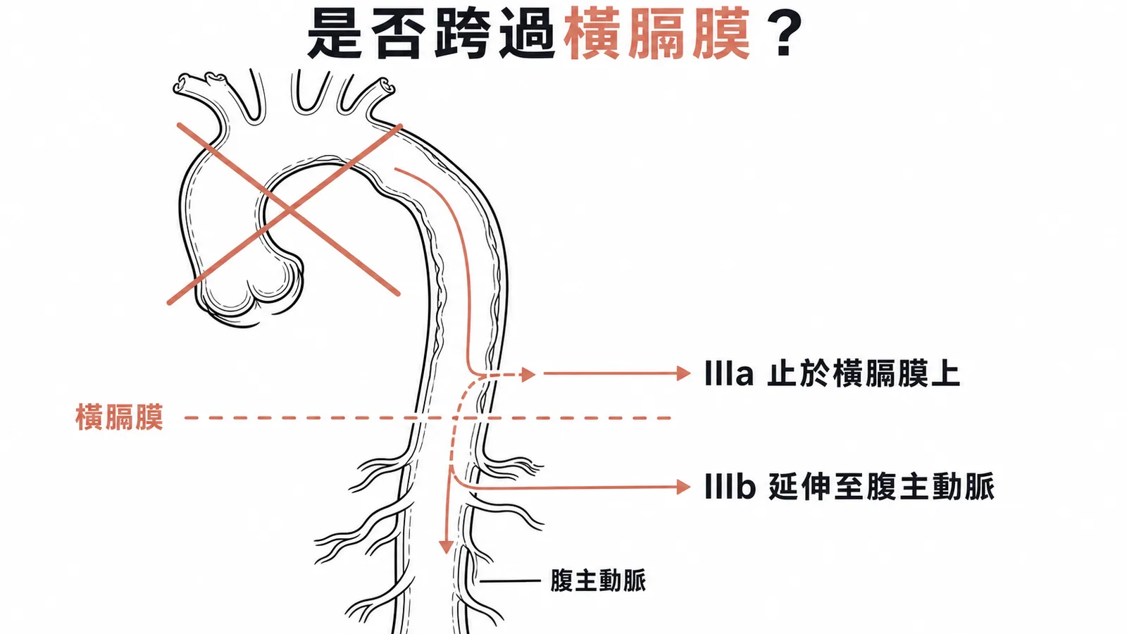 DeBakey主動脈剝離IIIa與IIIb分界：是否跨過橫膈膜延伸至腹主動脈