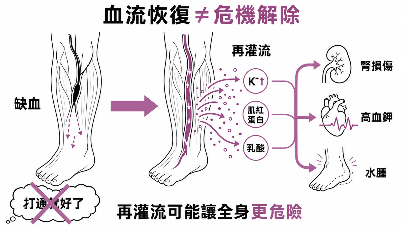 急性肢體缺血再灌流：血流恢復後釋放K+、肌紅蛋白、乳酸造成全身併發症