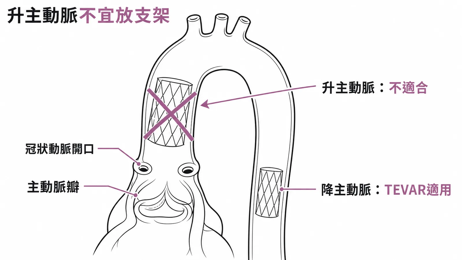 升主動脈瘤因靠近冠狀動脈開口與主動脈瓣不適合放血管內支架
