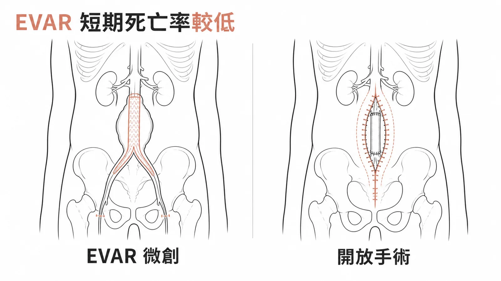 EVAR微創治療腹主動脈瘤短期住院死亡率較開放手術低