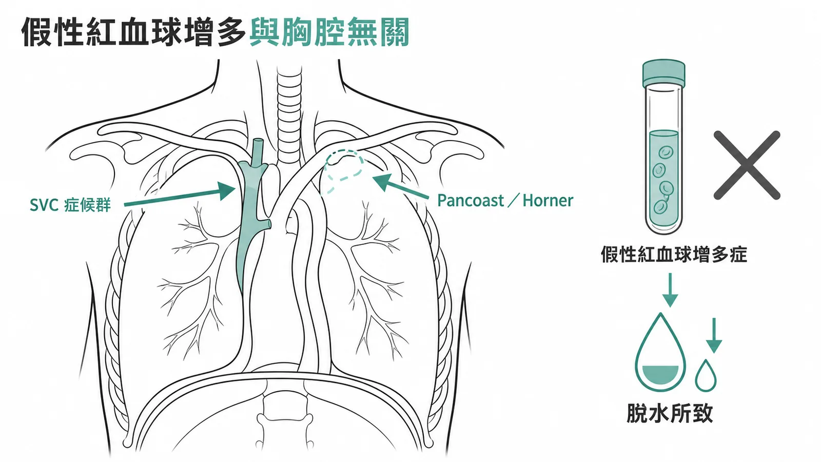 假性紅血球增多症因脫水所致與胸腔腫瘤壓迫症候群無關