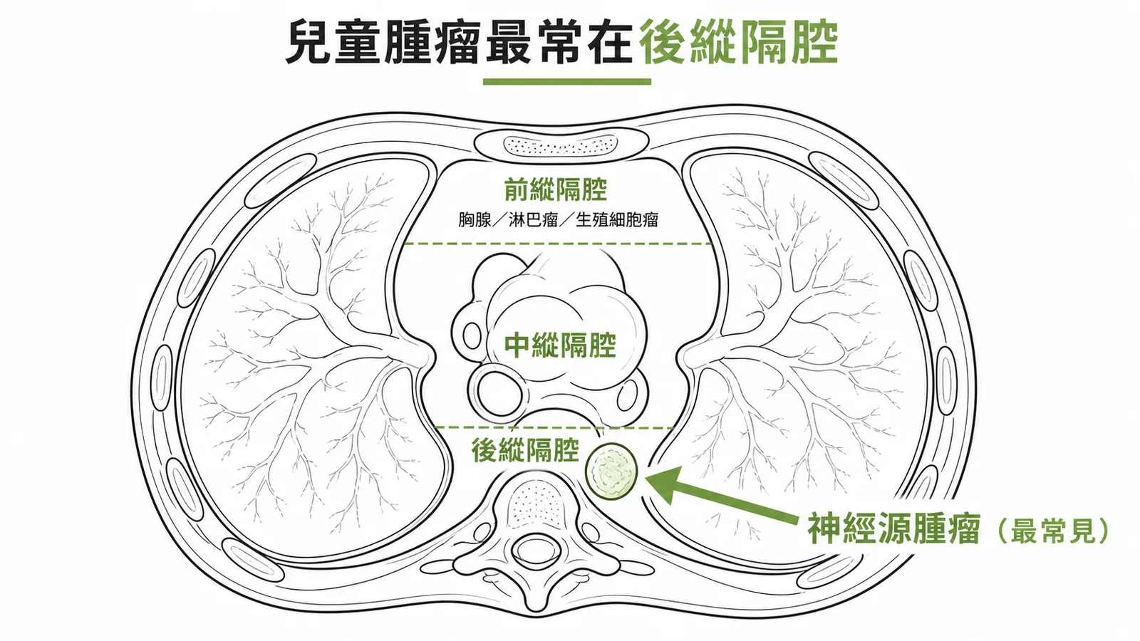 兒童縱隔腔腫瘤最常見為後縱隔腔的神經源腫瘤