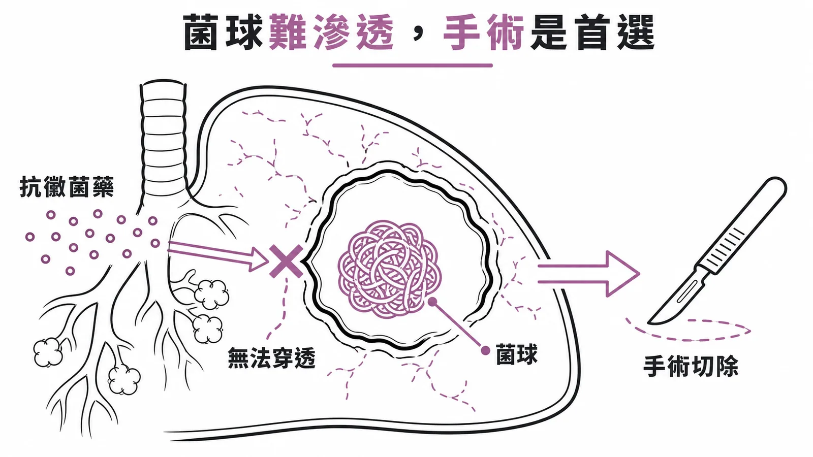 曲黴菌球在肺空腔內血供差藥物難穿透手術切除是首選
