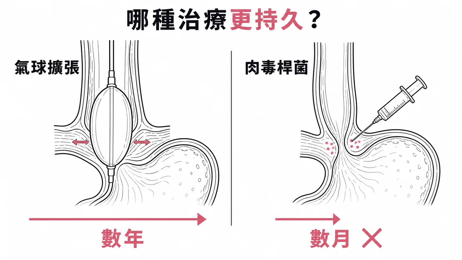 賁門弛緩不能治療：氣球擴張效果持續數年比肉毒桿菌數月更持久