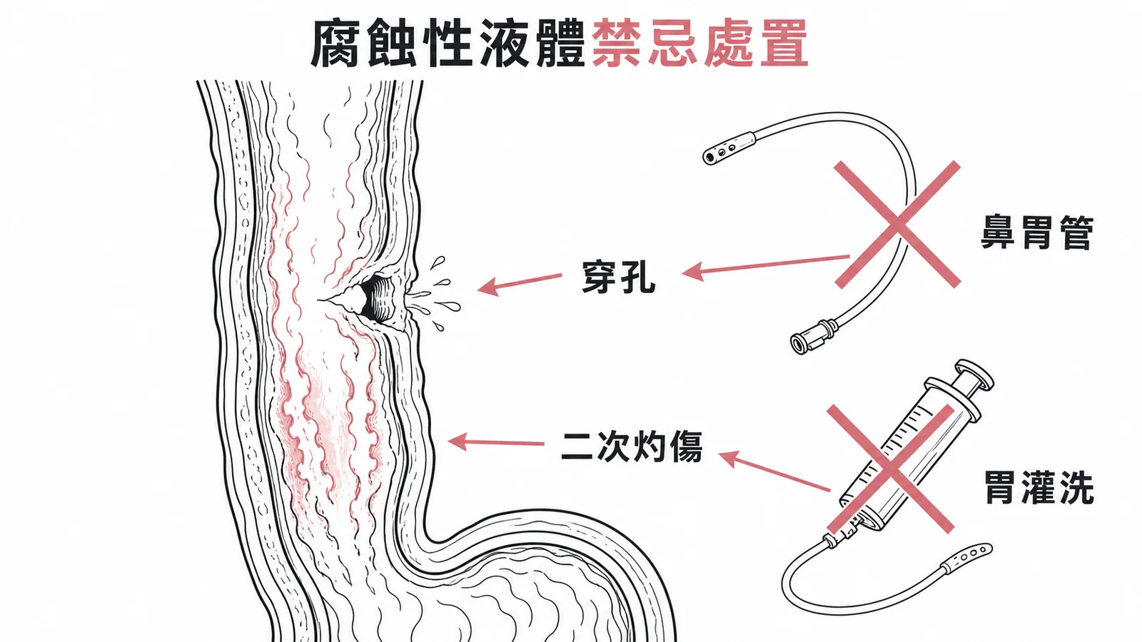 腐蝕性液體禁忌處置：鼻胃管與胃灌洗打叉，箭頭指向穿孔與二次灼傷