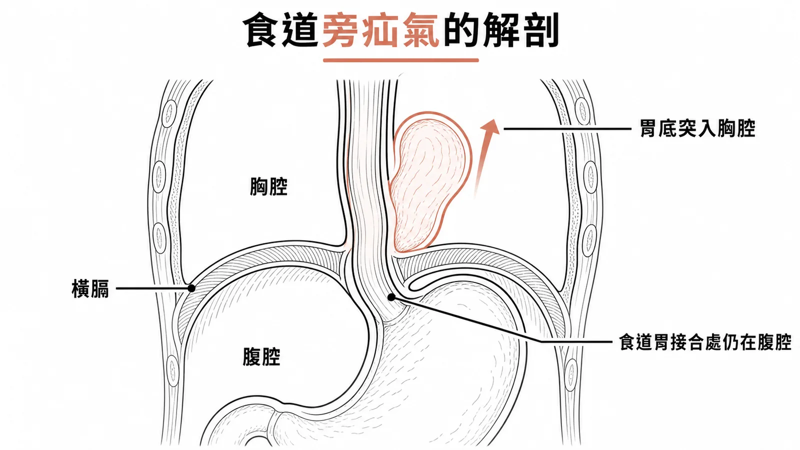 食道旁疝氣解剖：胃底從食道裂孔旁突入胸腔，食道胃接合處仍在腹腔