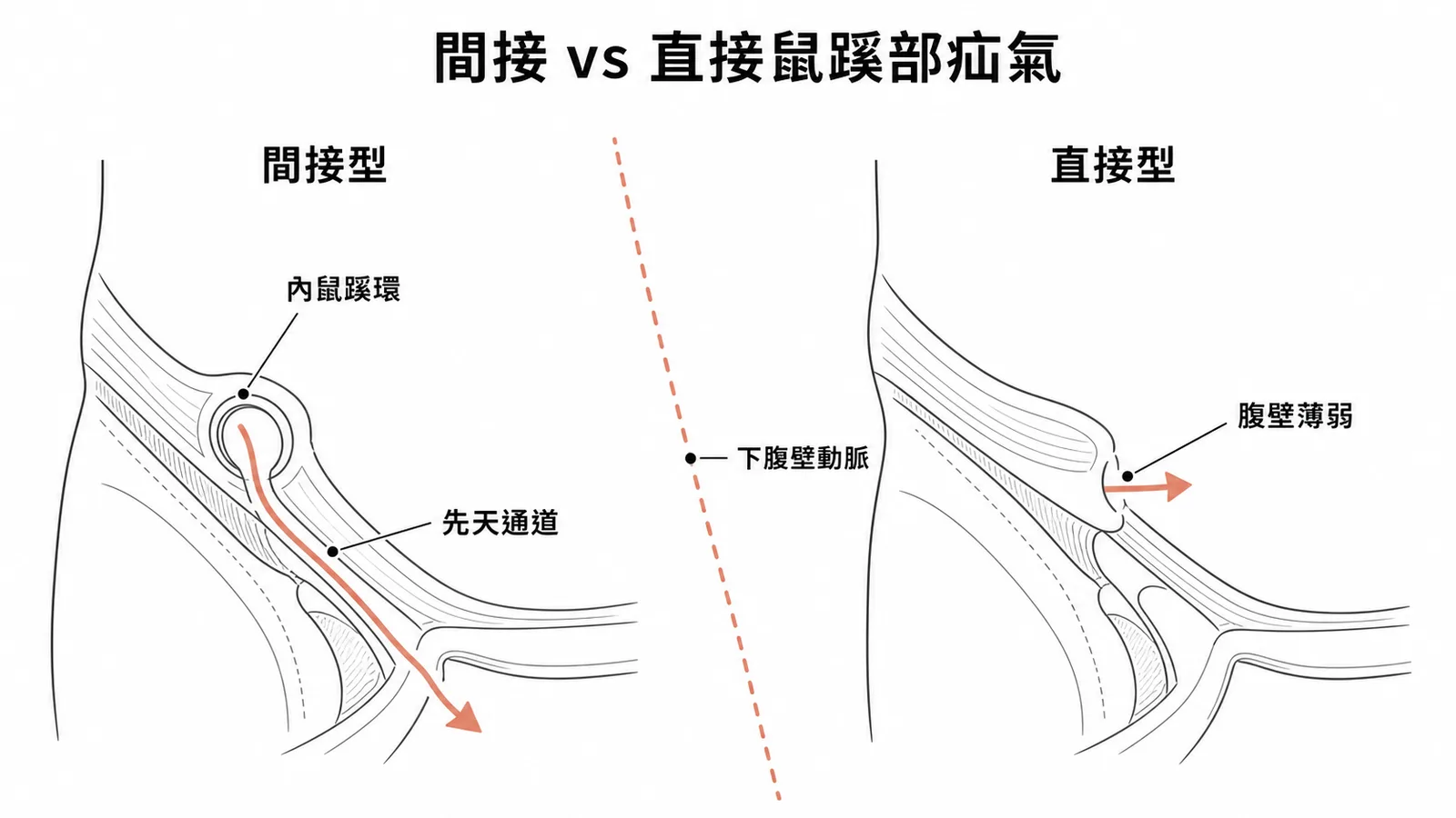 間接型與直接型鼠蹊部疝氣的解剖對照：內鼠蹊環先天通道 vs Hesselbach 三角腹壁薄弱