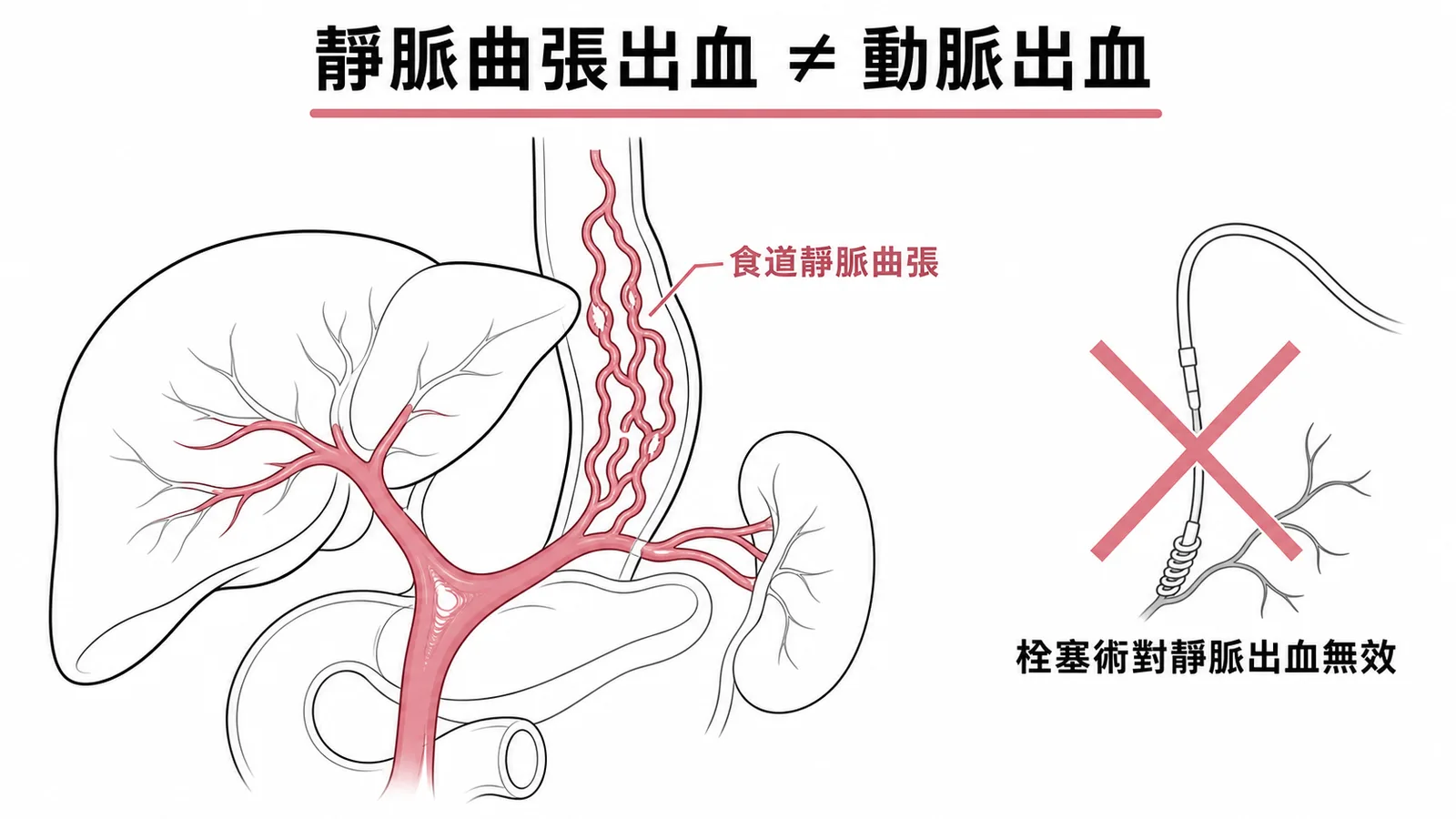 食道靜脈曲張出血源自門靜脈高壓，血管攝影栓塞術對靜脈出血無效