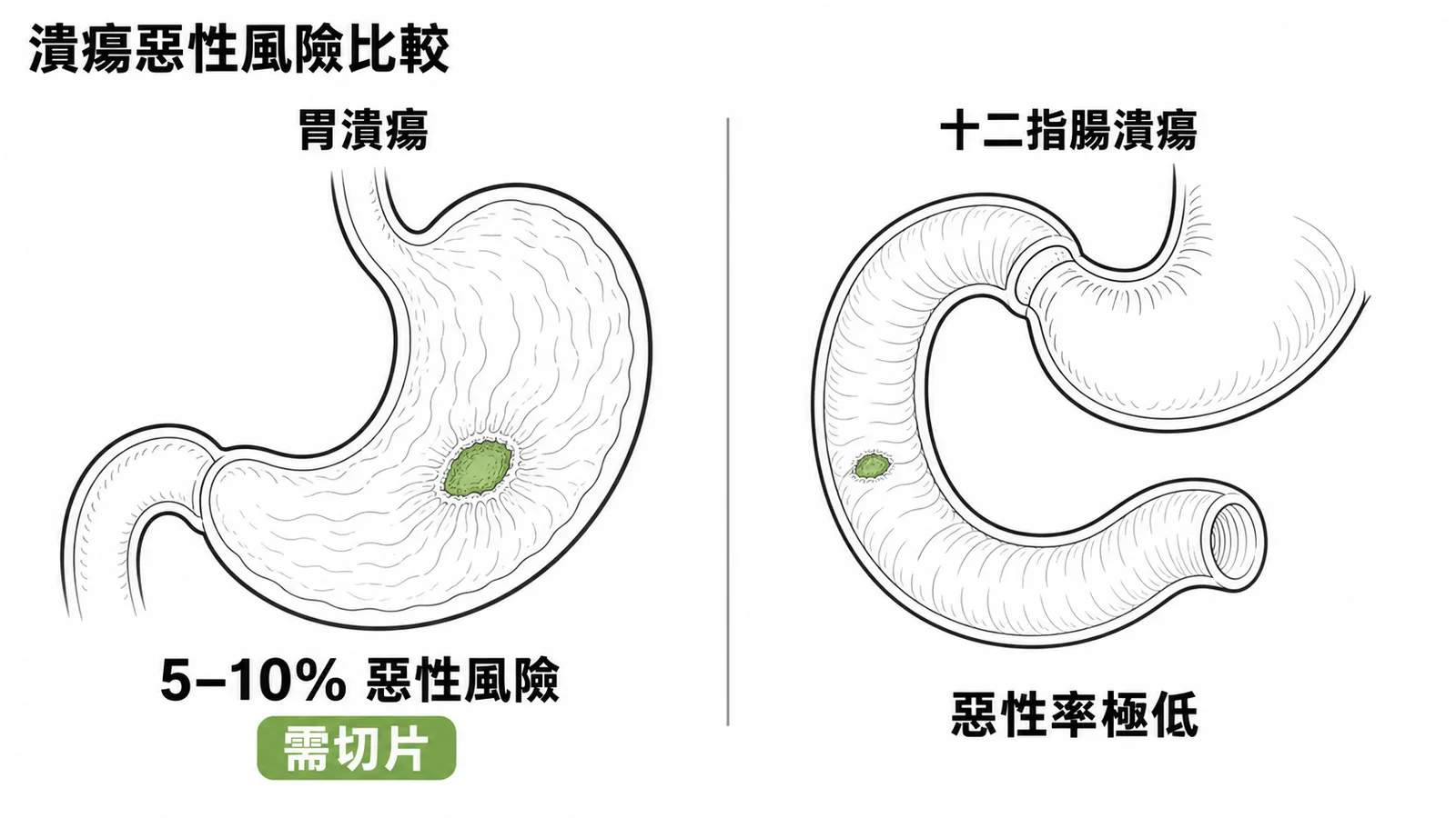 胃潰瘍 5-10% 惡性風險需切片 vs 十二指腸潰瘍惡性率極低