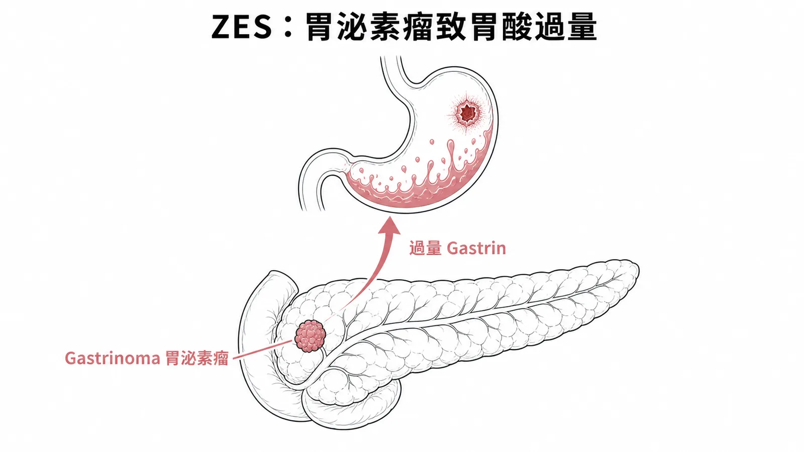 ZES 機轉：胰臟胃泌素瘤分泌過量 Gastrin 致胃酸過度分泌