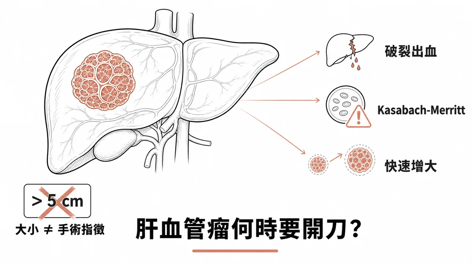 肝血管瘤手術指徵是症狀併發症而非大小，大於五公分不等於要開刀