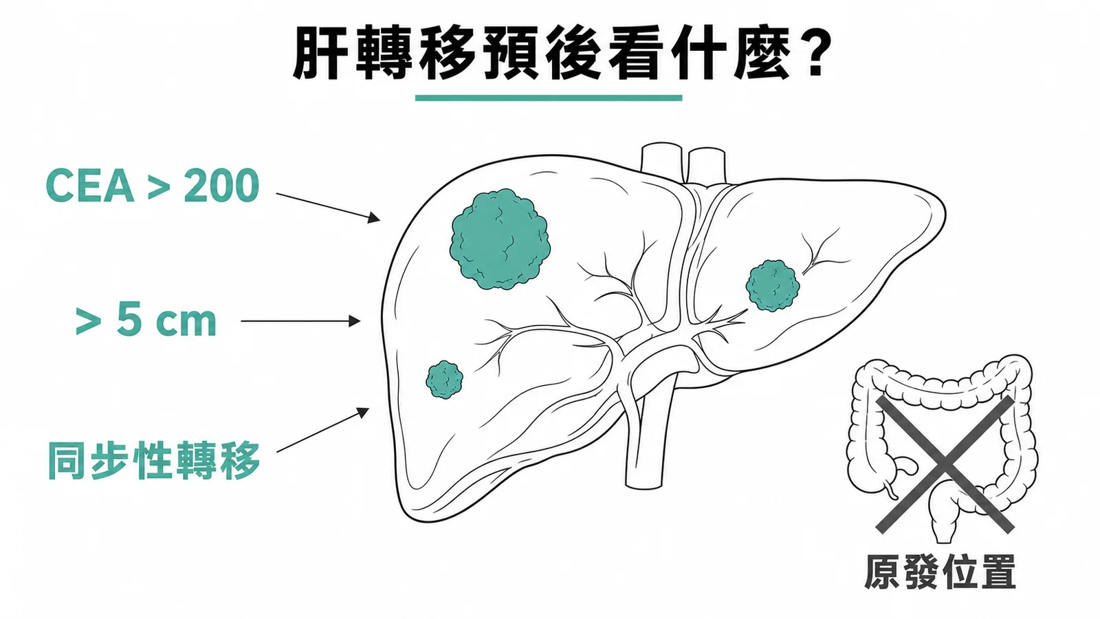 大腸癌肝轉移預後因子：CEA、腫瘤大小、同步性轉移為主，原發位置非主要因子