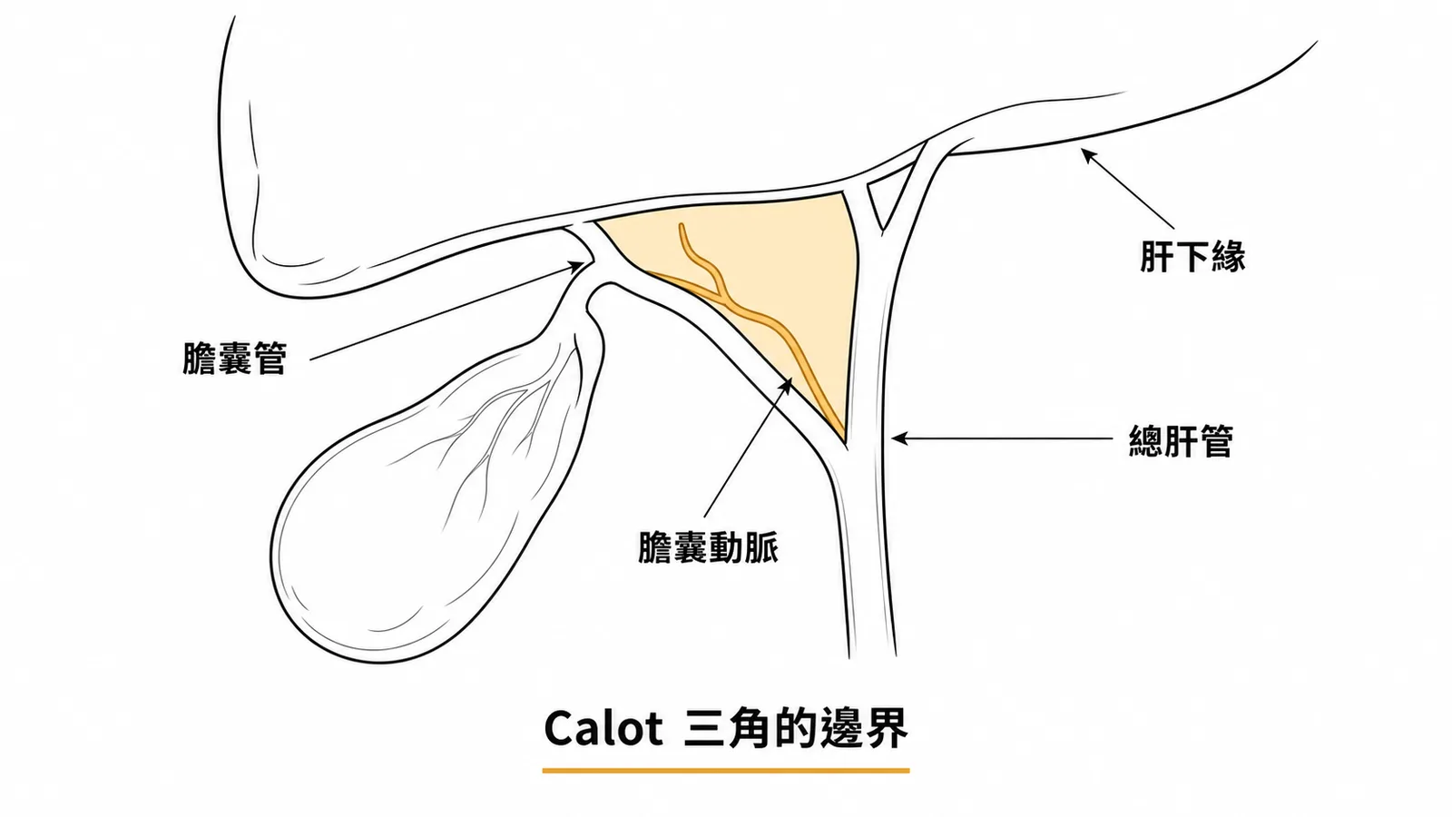 Calot 三角邊界：膽囊管、總肝管、肝下緣，三角內含膽囊動脈