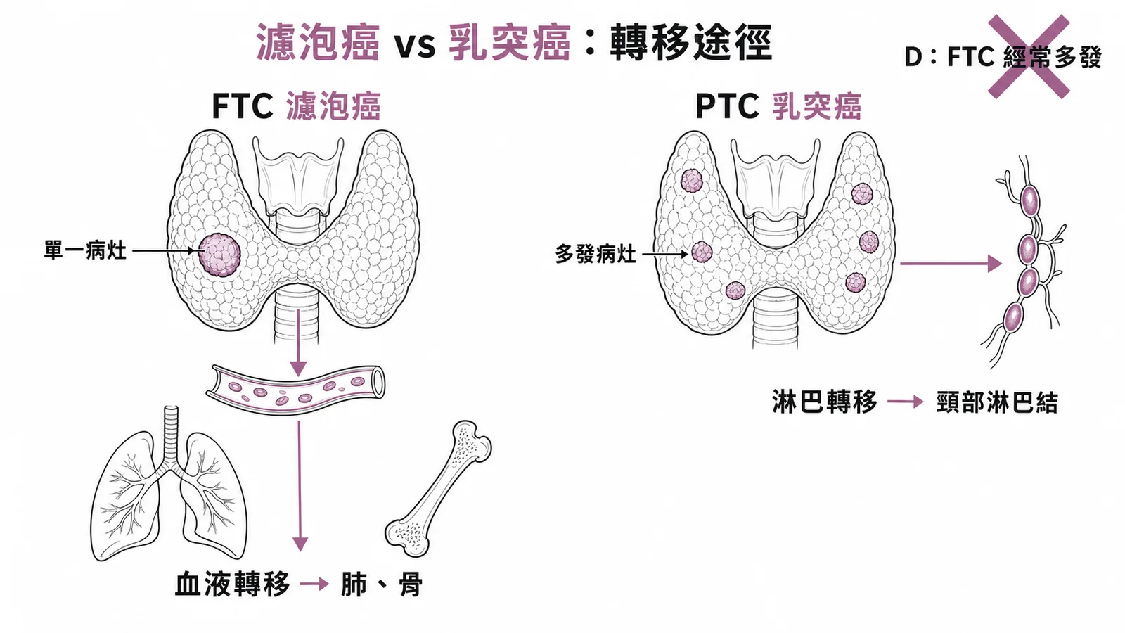 濾泡癌(FTC)與乳突癌(PTC)轉移途徑對比:FTC 血液轉移至肺骨、單一病灶;PTC 淋巴轉移至頸部、多發病灶