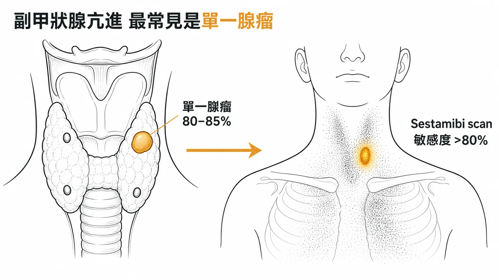 原發性副甲狀腺機能亢進最常見病因為單一腺瘤(80-85%)，Sestamibi scan 定位敏感度大於80%