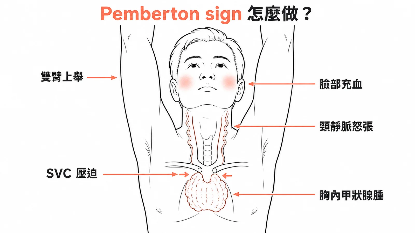 Pemberton sign操作示意：雙臂上舉後出現臉部充血與頸靜脈怒張，代表胸內甲狀腺腫壓迫上腔靜脈