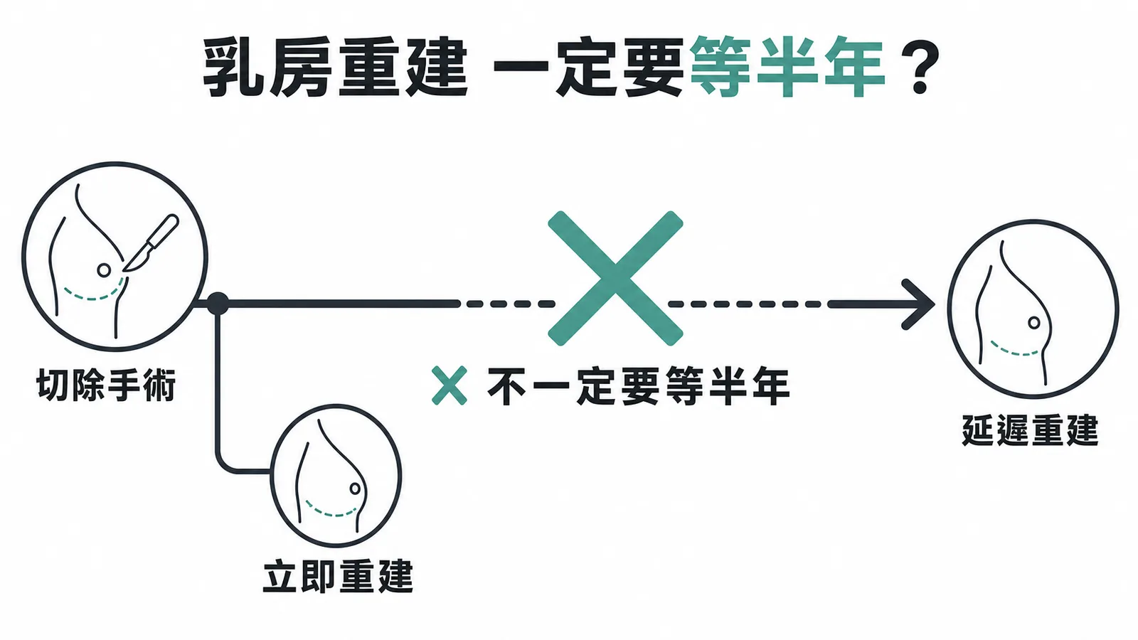 乳房重建時機示意：立即重建可在切除同時進行，不一定要等化療後半年