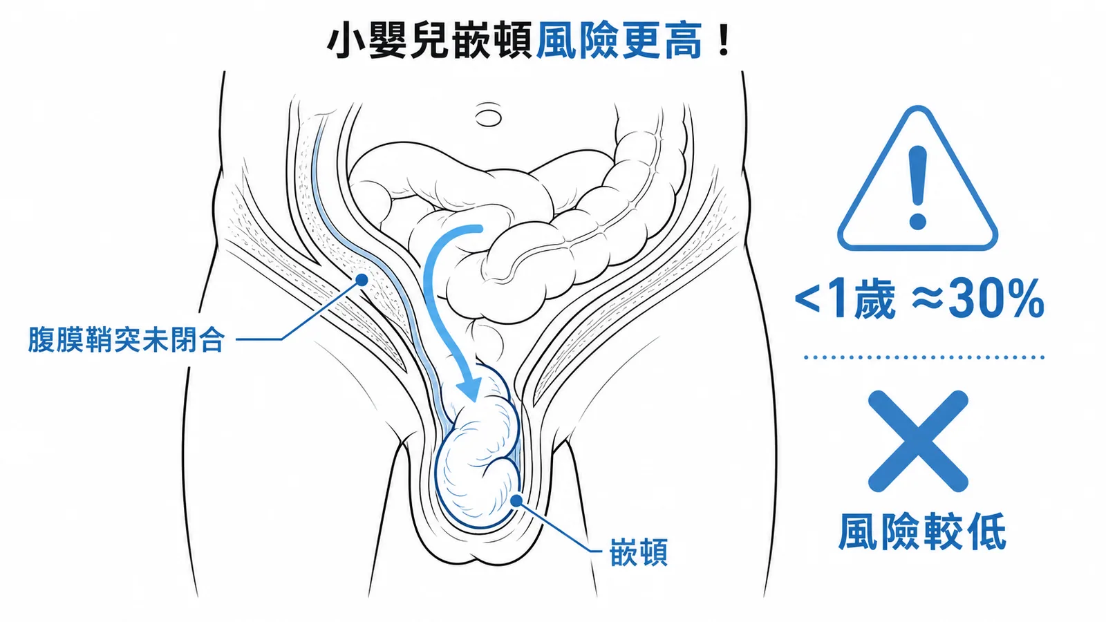 兒童先天性鼠蹊疝氣示意：腹膜鞘突未閉合致腸道突出，小於一歲嵌頓率高達30%