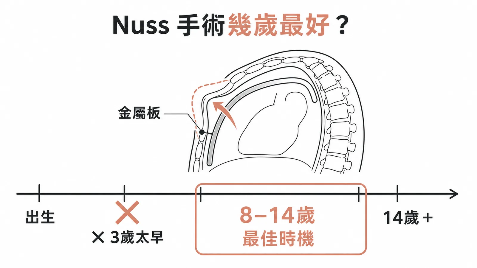 漏斗胸Nuss手術最佳年齡為8-14歲青春期前，3歲太早復發率高