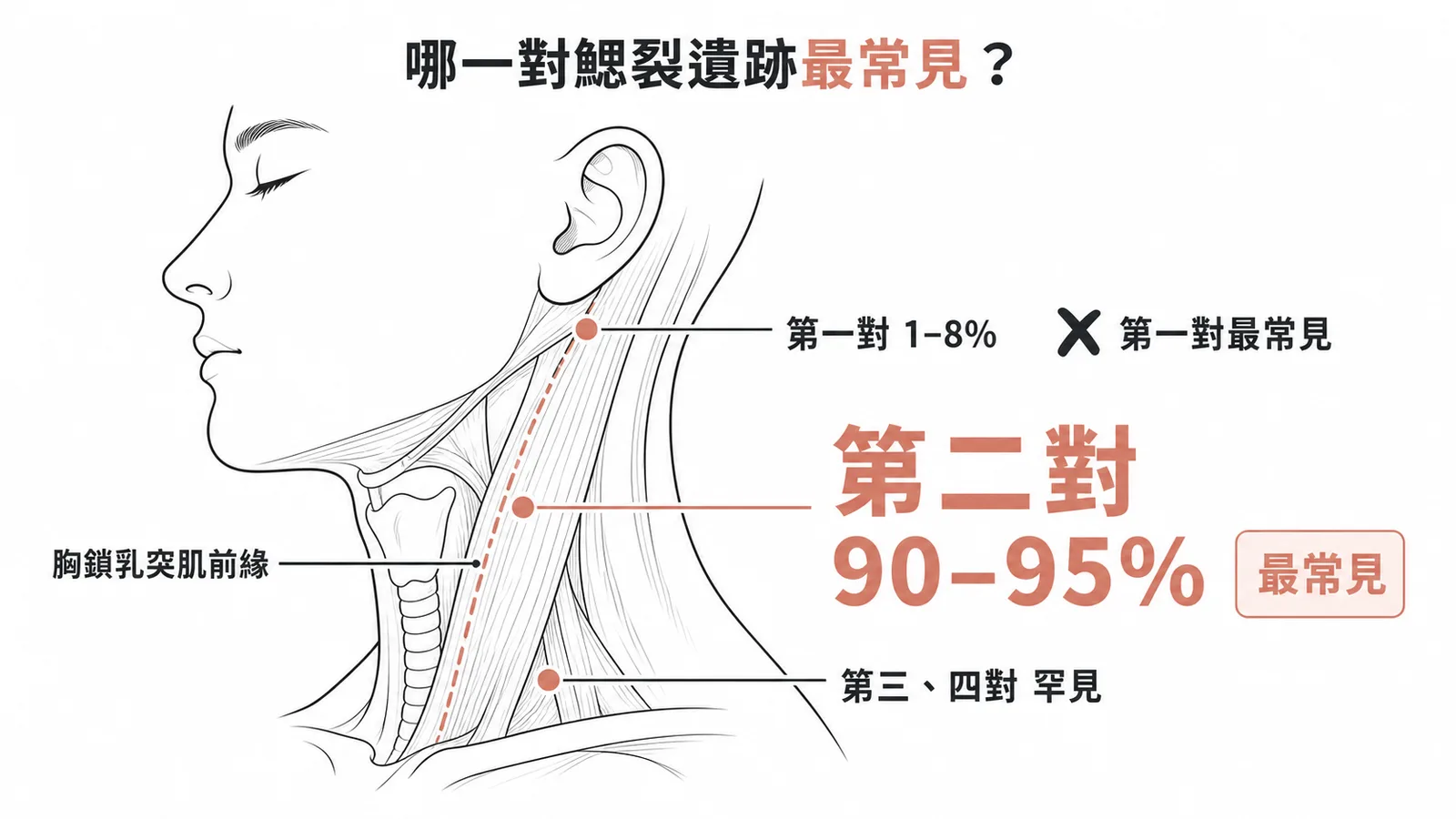 鰓裂遺跡好發位置：第二對最常見(90-95%)位於頸部中下段胸鎖乳突肌前緣，第一對僅1-8%