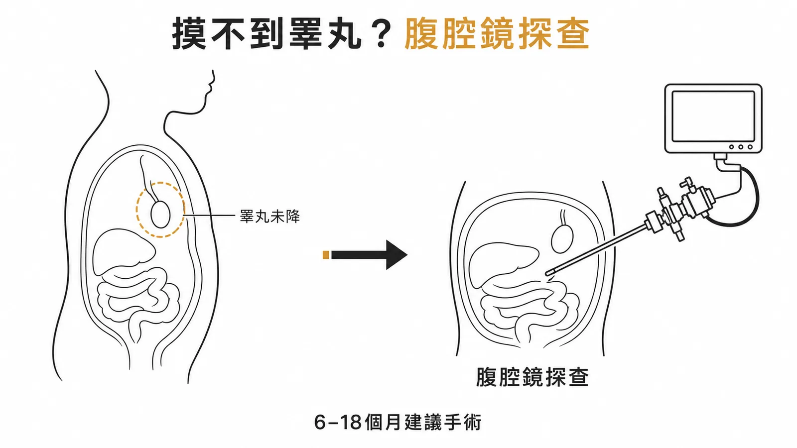 隱睪症：摸不到睪丸時應以腹腔鏡探查確認位置