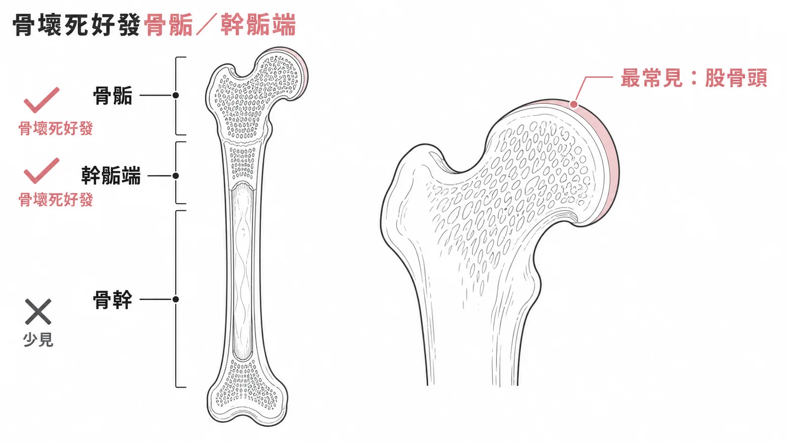 骨壞死好發於骨骺與幹骺端,股骨頭最常見,骨幹少見