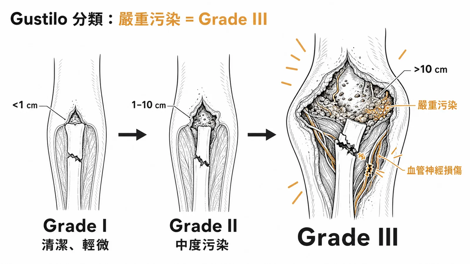 開放性骨折Gustilo分類：嚴重污染歸Grade III而非Grade II