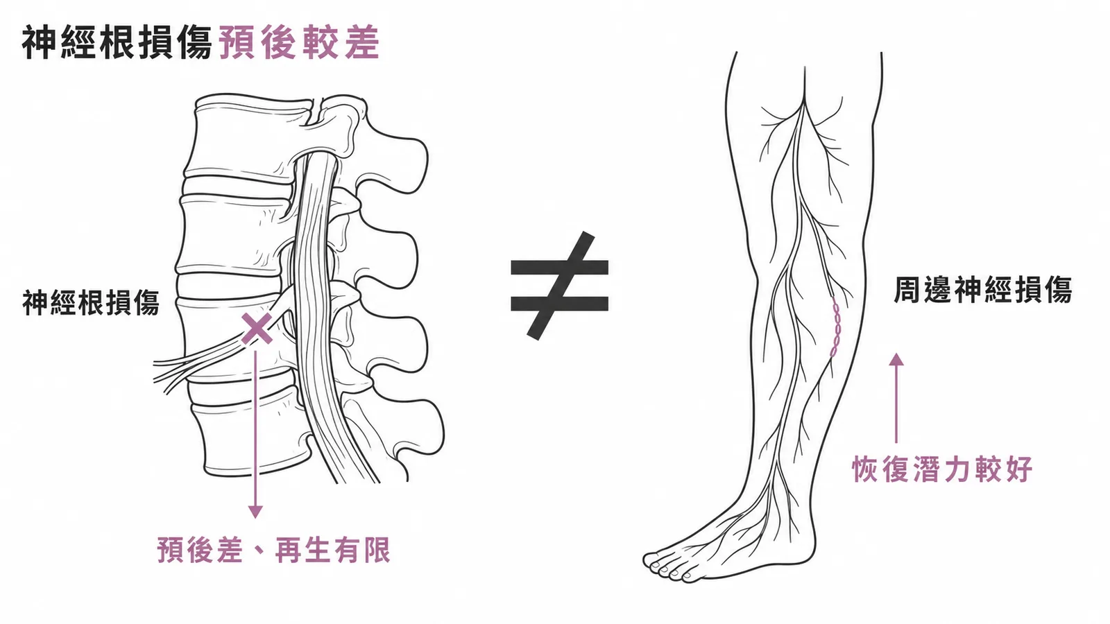 神經根損傷預後較周邊神經差，再生能力有限