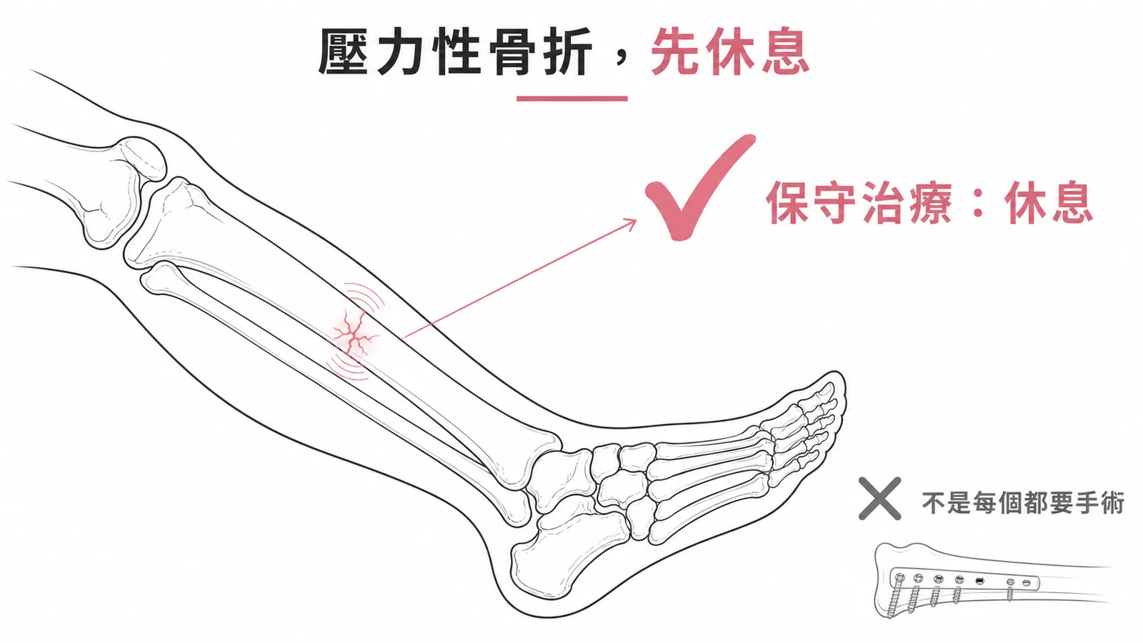 壓力性骨折治療原則：保守治療優先，手術僅用於少數高風險部位