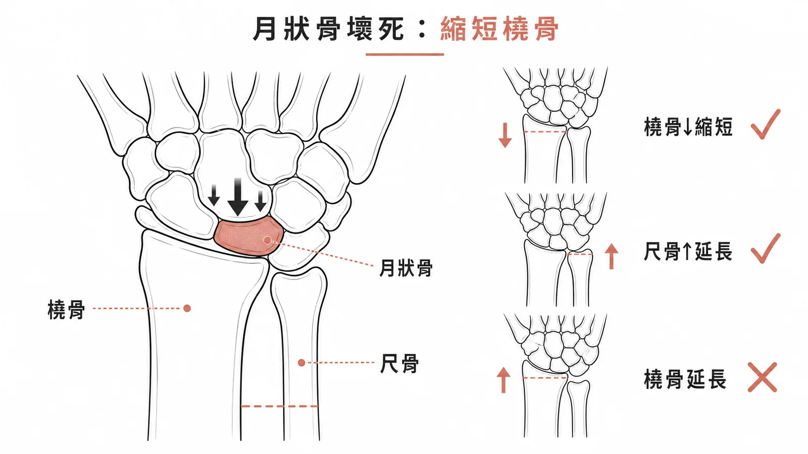 月狀骨缺血性壞死治療:縮短橈骨或延長尺骨來減壓,橈骨延長是錯誤的