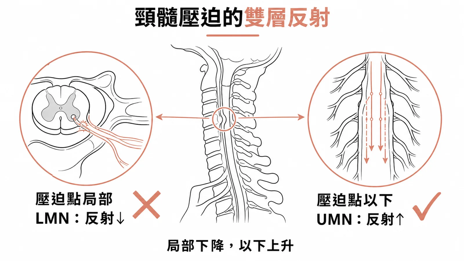 頸髓壓迫的雙層反射：壓迫點局部LMN反射下降，壓迫點以下UMN反射上升
