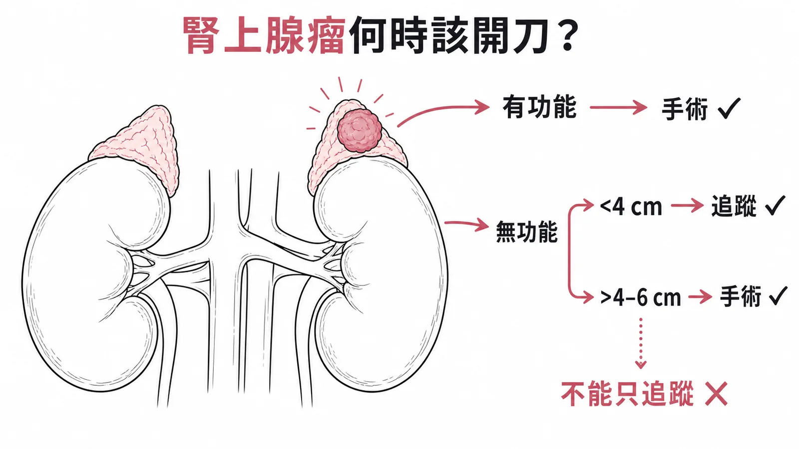 腎上腺瘤處理原則：依功能性和大小決定手術或追蹤，大瘤不能只追蹤