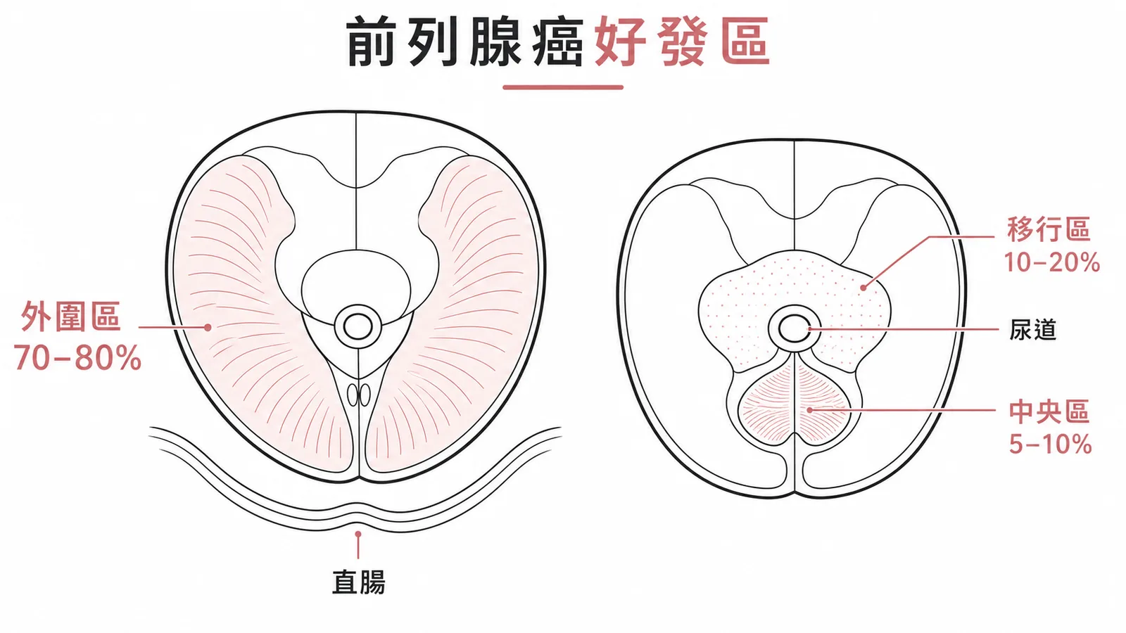 前列腺癌好發區：外圍區70-80%、移行區10-20%、中央區5-10%