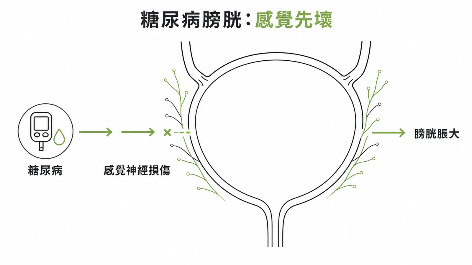 糖尿病膀胱病變：感覺神經最先受損，膀胱感覺遲鈍導致容量增大