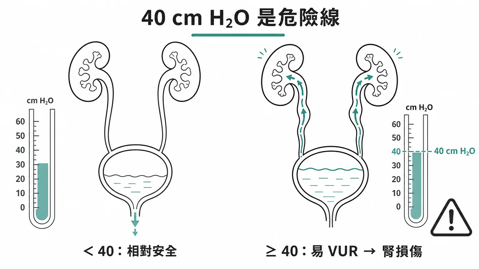 小兒神經性膀胱危險閾值：膀胱壓力≥40 cm H₂O 易致VUR與腎損傷