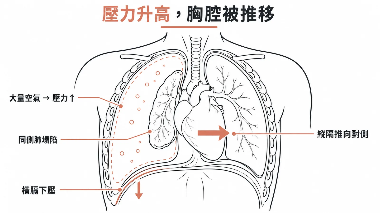 張力性氣胸三大特徵：同側肺塌陷、縱隔腔推向對側、橫膈膜下壓