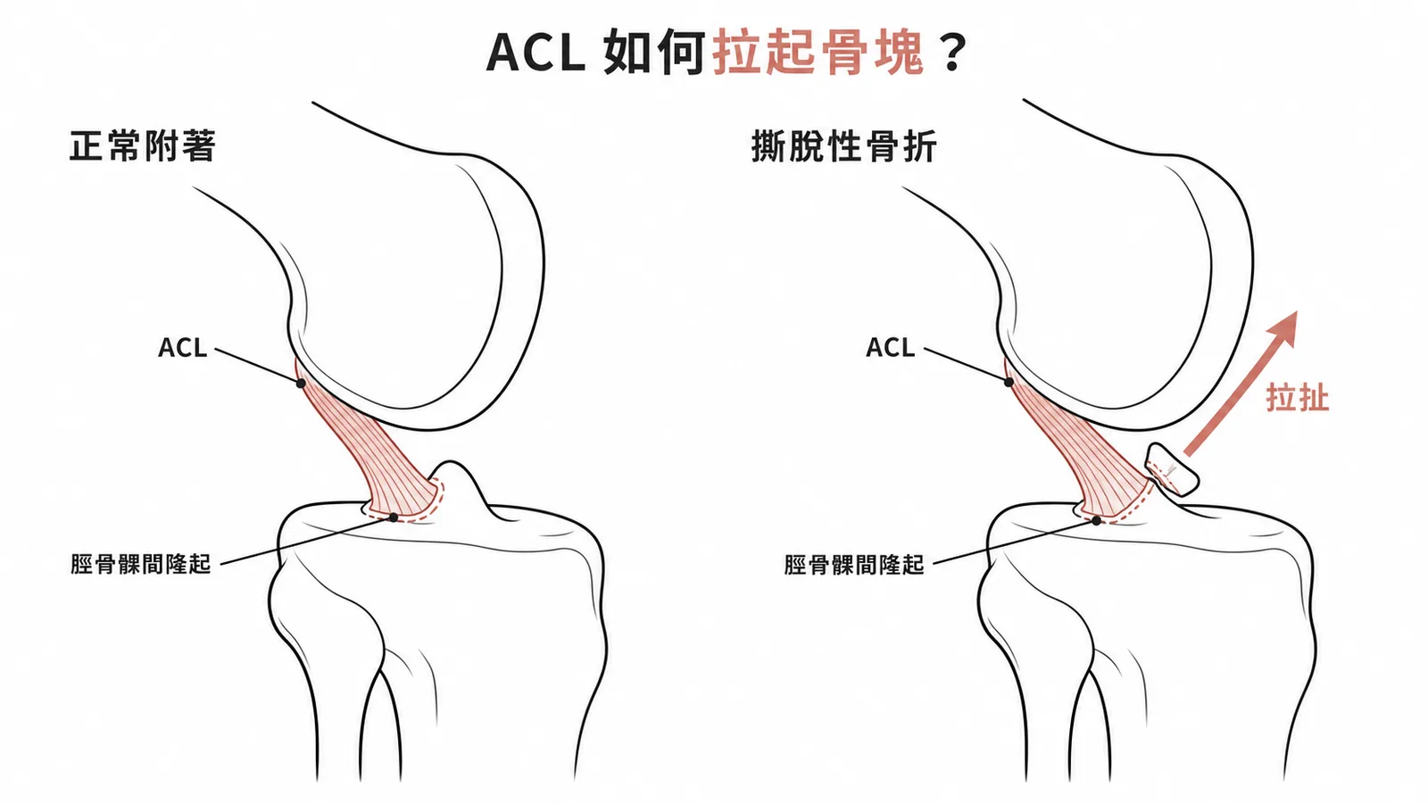 ACL撕脫性骨折:前十字韌帶拉扯脛骨髁間隆起造成骨塊脫離