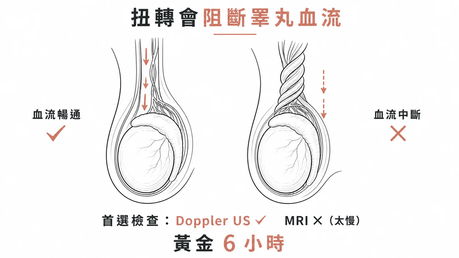 睪丸扭轉阻斷血流，首選Doppler US而非MRI，黃金6小時