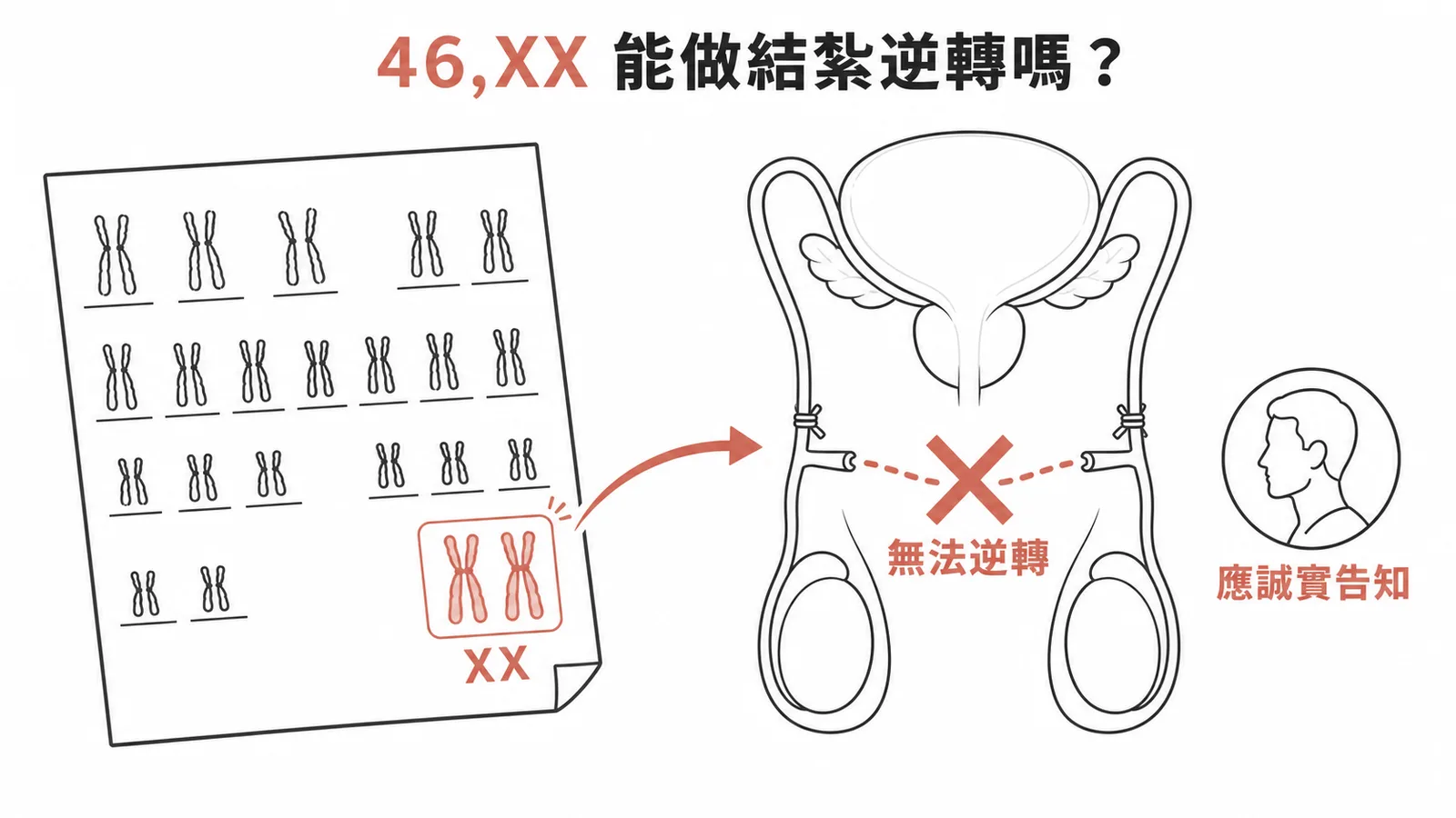 46,XX染色體核型無法施行男性結紮逆轉手術，應誠實告知病人