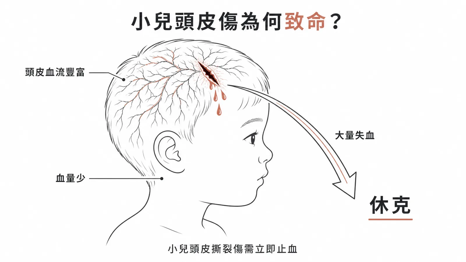 小兒頭皮撕裂傷可快速導致失血性休克