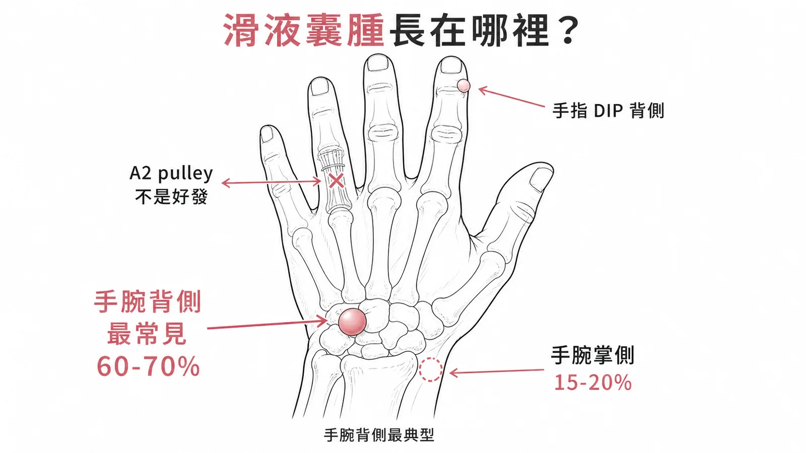 滑液囊腫三大好發位置示意圖