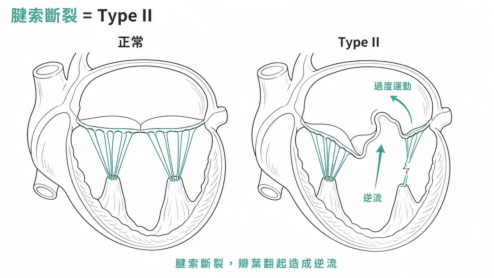 Carpentier 僧帽瓣逆流分類 Type II 腱索斷裂致瓣膜過度運動