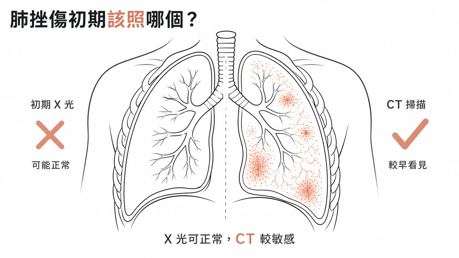 肺挫傷初期 X 光可能正常而 CT 更敏感